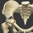 Periacetabular Osteotomy